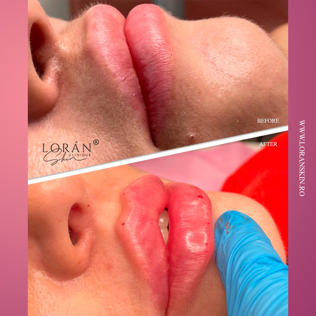 marire buze București