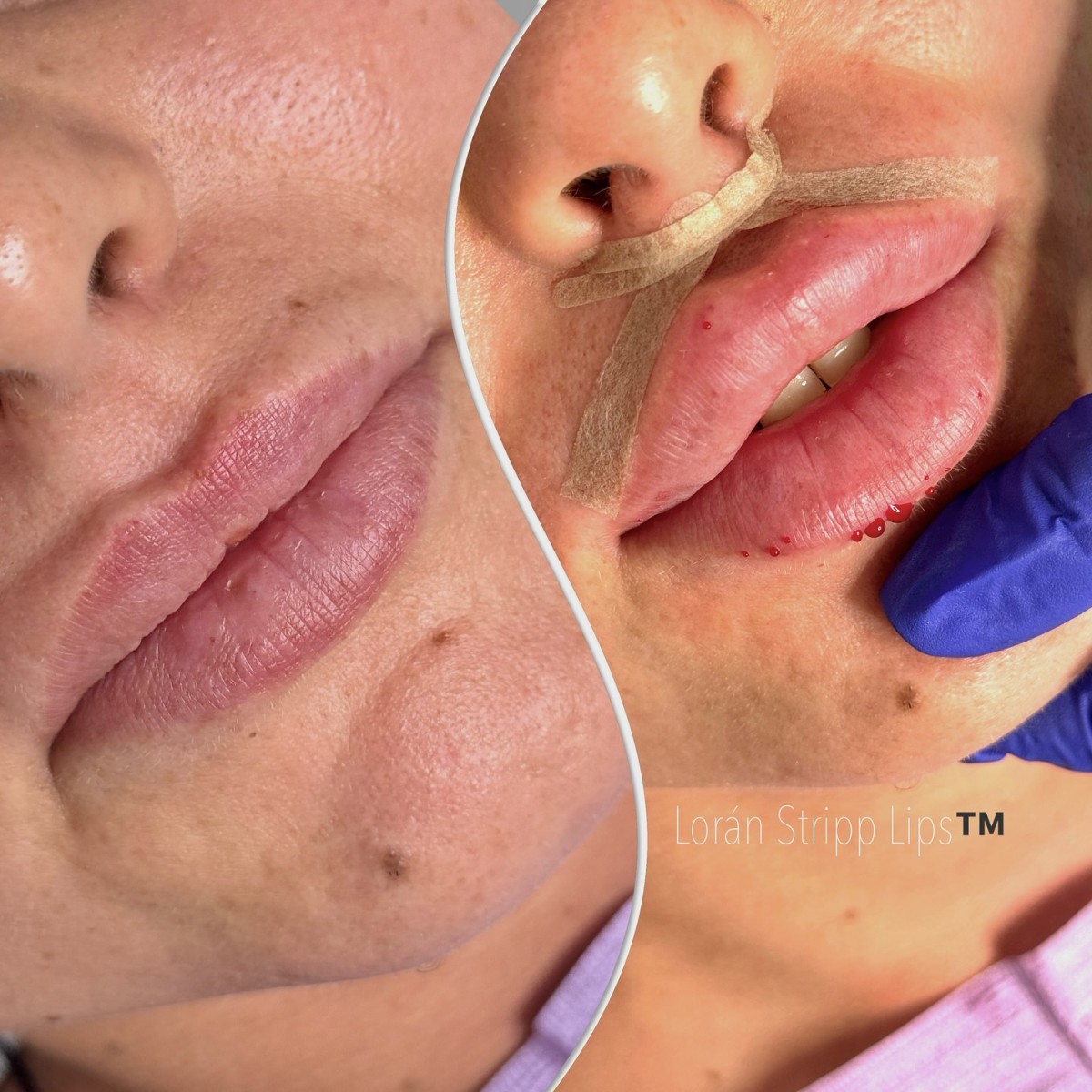 marire buze București